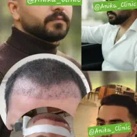 کاشت مو با استاندارد های بین المللی