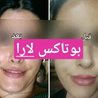 کرم بوتاکس و چاقی صورت لارا|آرایشی، بهداشتی، درمانی|مرودشت, ثبت احوال|دیوار