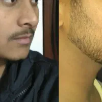 رویش ضخامت ریش