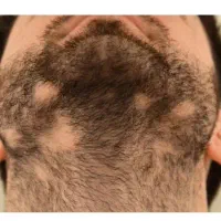 ریزش موی سکه ای