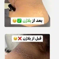 پلاژن روشن سازی|آرایشی، بهداشتی، درمانی|شیراز, معالیآباد|دیوار