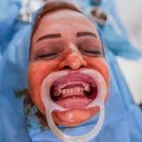 دندانپزشکی اقساطی (ایمپلنت)