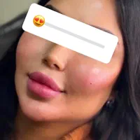 اف ویژه ژل بوتاکس بندرعباس