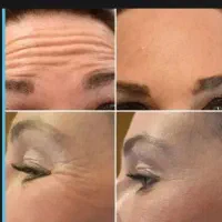 بوتاکس و خدمات ژل