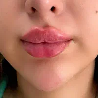 تزریق ژل و بوتاکس در شرق تهران