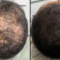 جشنواره میکرواسکالپ تخصصی ،اسکالپ ،مکمل کاشت مو