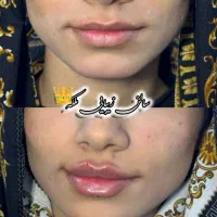 فیلر و بوتاکس ....