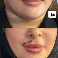تخفیفات استثنایی ژل و بوتاکس در مطب زیبایی|خدمات آرایشگری و زیبایی|قم, زنبیل آباد|دیوار