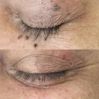 خدمات لیزر خال و منگوله های گوشتی،همورییدوزیگیل|خدمات زیبایی و سلامت|تهران, مسعودیه|دیوار