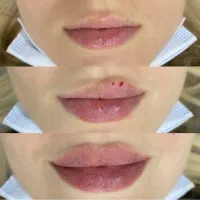 جشنواره ژل لب چانه زاویه جوانسازی بوتاکس لیفت|خدمات آرایشگری و زیبایی|تهران, گیشا|دیوار