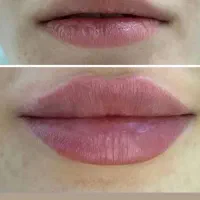 ژل .بوتاکس.انزیم،انواع پرسینگ با بهترین کیفیت.