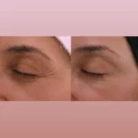 بوتاکس فقط ۹۵۰ ( پیشانی لبخند لثه ای زیر بغل و..)|خدمات آرایشگری و زیبایی|محمدیه-قزوین, |دیوار