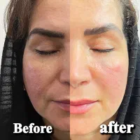 هایفو،جوانسازی صورت تخفیف عیدانه فقط۲.۸۰۰.۰۰۰ت