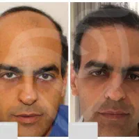رفع ریزش + تقویت و پرپشتی مو