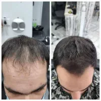 تار های مو هنوز امید دارن