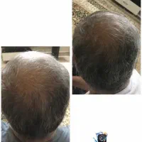 قطره ریزش|آرایشی، بهداشتی، درمانی|کاشان, فاز ۲ ناجی آباد|دیوار