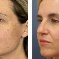 آف تزریق انواع مزوژل توسط شخص پزشک در مطب زیبایی