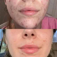 کرم سفید کننده ضدلک وضدجوش اصل سورو|آرایشی، بهداشتی، درمانی|بندرعباس, |دیوار