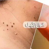 برداشتن انواع خال زگیل نشانه با مواد گیاهی تضمینی|خدمات آرایشگری و زیبایی|کرمانشاه, |دیوار