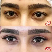 تخفیف ویژه بلفاروپلاستی ۱۲۹۰۰