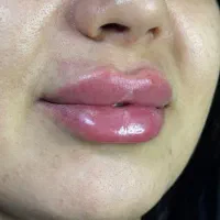 ژل لب و فول فیس و مدلینگ صورت