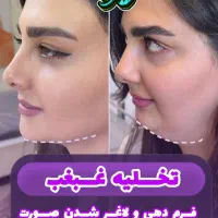 ساکشن غبغب توسط جراح (کلنیک ایرانا)