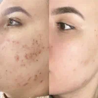 از بین بردن انواع لک صورت|خدمات آرایشگری و زیبایی|فردیس, فردیس|دیوار