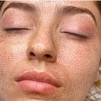 دستگاه پلکسر بدون بخیه|آرایشی، بهداشتی، درمانی|محمودآباد, |دیوار