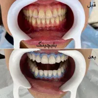کامپوزیت دندان کامپوزیت زیبایی لمینیت دندان|خدمات آرایشگری و زیبایی|قم, قلعه یزدیها|دیوار