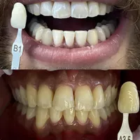 سفید کردن دندان (بلیچینگ)|خدمات آرایشگری و زیبایی|فولادشهر, B2|دیوار