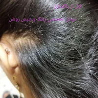 درمان سریع و گیاهی رشک و شپش بدون مواد شیمیایی|خدمات آرایشگری و زیبایی|یزد, |دیوار