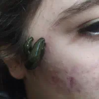 حجامت،زالودرمانی،اصلاح ستون فقرات ودیسک کمر