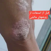داغی یا گرگرفتگی داری مثل چراغ مثل بخاری