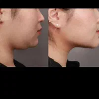 ژل بوتاکس ساکشن غبغب پی ار پی هایفو لیزر لاغری