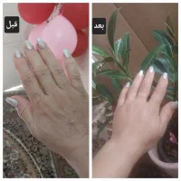 تزریق بوتاکس و پی ار پی و مزو و فیلر