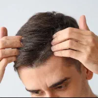 درمان ریزش مو با اسکالپ