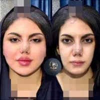 تزریق تخصصی ژل ومادلینگ خلیجی واروپایی وبوتاکس|خدمات آرایشگری و زیبایی|کرمانشاه, |دیوار