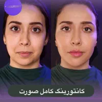 جشنواره تزریق ژل و بوتاکس در مطب پزشک بصورت اقساط|خدمات آرایشگری و زیبایی|یزد, |دیوار