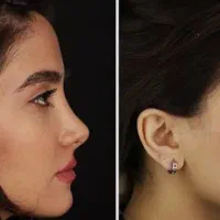 عمل بینی ۳ماه تنفس پرداخت قسط با ضمانت نامه کتبی