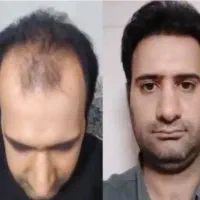 کاشت مو آقایان