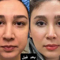 بلفاروپلاستی پلک