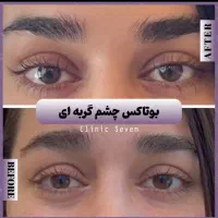 بوتاکس ژل صورت و بدن|خدمات آرایشگری و زیبایی|بیرجند, |دیوار