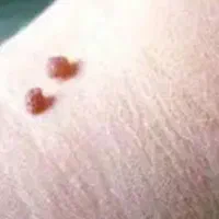 زگیل تناسلی|خدمات آرایشگری و زیبایی|تبریز, |دیوار