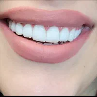 کامپوزیت زیبایی دندان|خدمات آرایشگری و زیبایی|رشت, دباغیان|دیوار