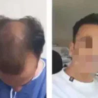 کاشت مو با خط رویش طبیعی