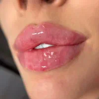 ژل بوتاکس لیزر تتو مزو خال زگیل تناسلی لک هیپ دیپ