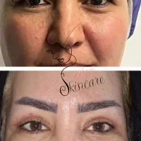 بلفاروپلاستی /سانترال لب/لیفت ابرو