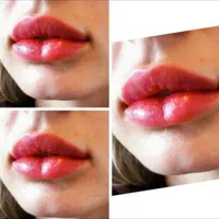 تزریق ژل و بوتاکس|خدمات آرایشگری و زیبایی|بیرجند, |دیوار