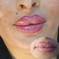 تزریق ژل ،فیلر بوتاکس مزو آنزیم خال برداری|خدمات آرایشگری و زیبایی|الیگودرز, |دیوار