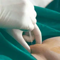 کاهش سایز شکم با روش امبدینگ در شهرکرد